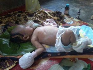 Ketiadaan Biaya, Balita Penderita Pembengkakan Pembuluh Darah Batal Berobat ke Medan