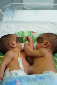 Bayi Kembar Siam Asal Taput Dirujuk ke RS Adam Malik