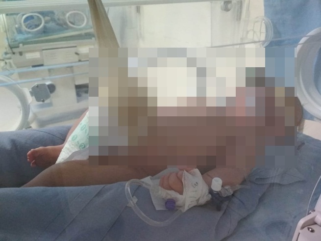 Miliki Usus Di Luar, Bayi Perempuan Ini Mendapat Perawatan Intensif Di RSUP Adam Malik