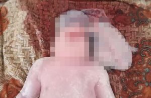Diduga Terpapar Zat Kimia, Bayi Di Madina ini Lahir Dengan Otak Di Luar Tempurung Kepala