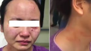 Tak Mau Dirawat, Pasien Positif Corona Malah Gigit Wajah Perawat