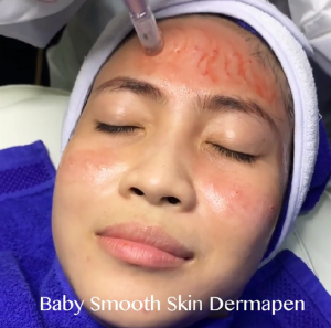 Cara Ampuh Mengatasi Bopeng Bekas Jerawat