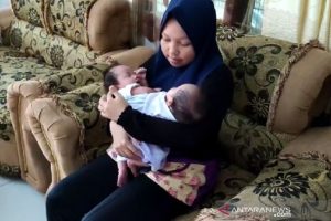 Terlahir Kembar Siam, Bayi di Deli serdang Ini Butuh Uluran Tangan